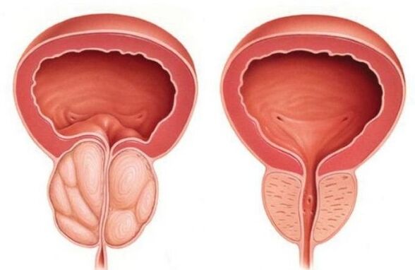 нормална и увеличена простата с простатит